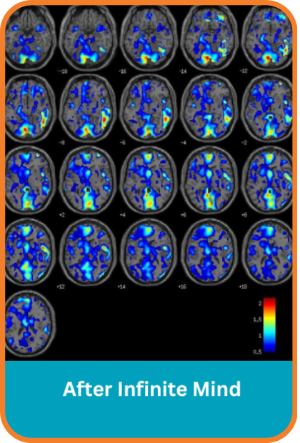 Deep brain stimulation scans after using infinite mind app