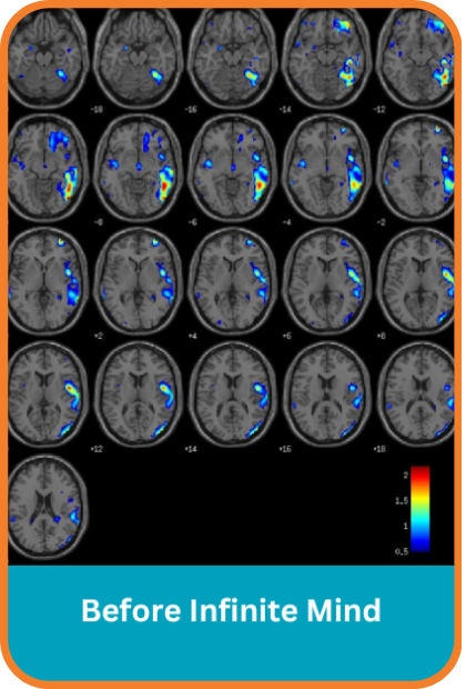 Deep brain stimulation scans before using infinite mind app